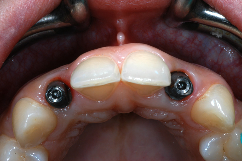 Agenesia dentaria e implantologia